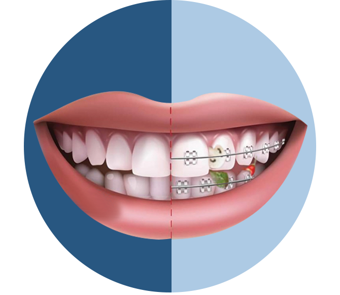 Invisible Braces compare Metal Braces In Teeth Mould Visual