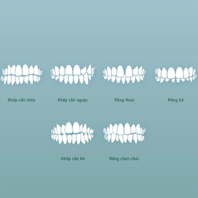 Tình trạng răng cần niềng răng để cải thiện